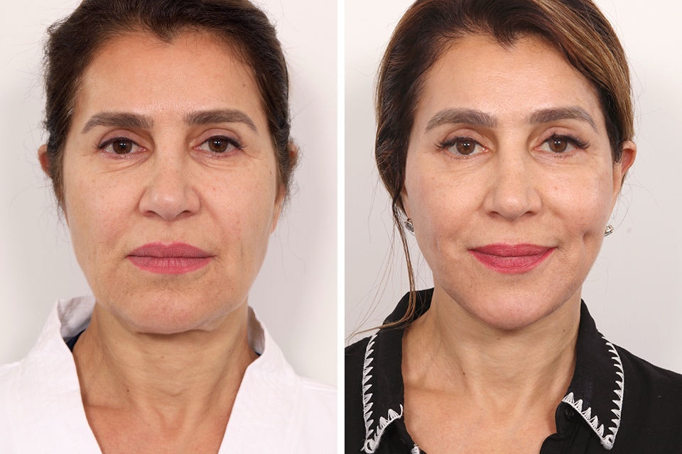 Browlift case #3267