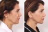 Browlift case #3267 slider thumbnail