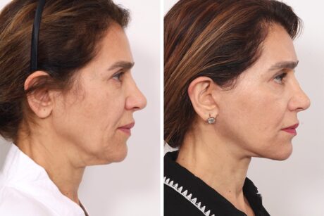 Browlift case #3267