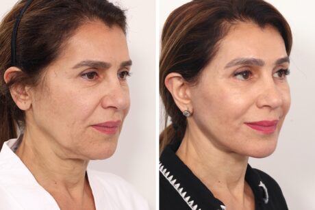 Browlift case #3267