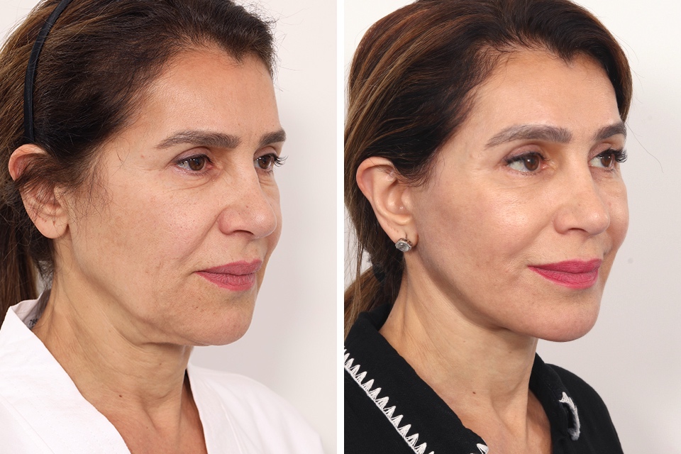 Browlift case #3267