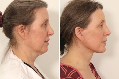 Facelift case #3518