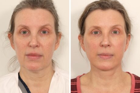 Facelift case #3518
