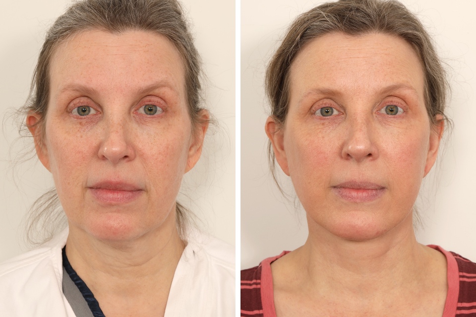 Facelift case #3518
