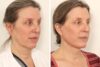 Facelift case #3518 slider thumbnail