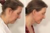 Facelift case #3518 slider thumbnail