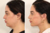 Eyelid Surgery case #3702 slider thumbnail
