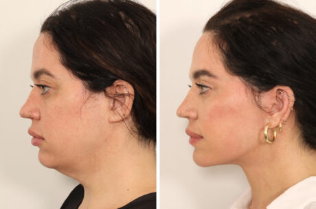 Eyelid Surgery case #3702