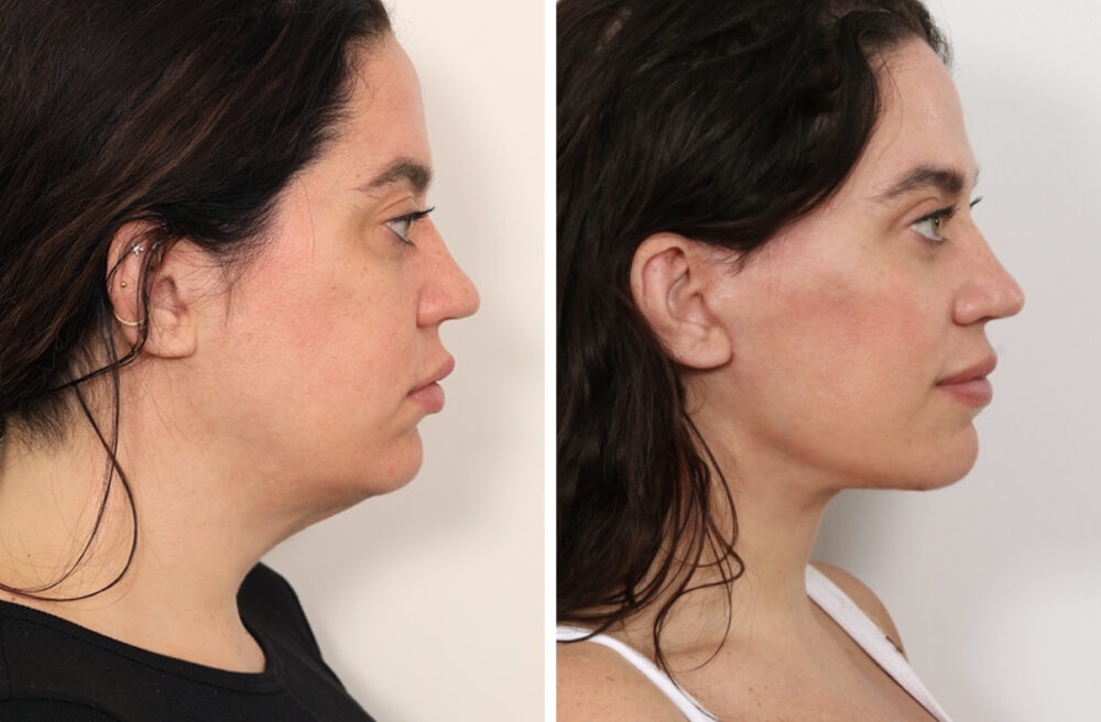 Eyelid Surgery case #3516