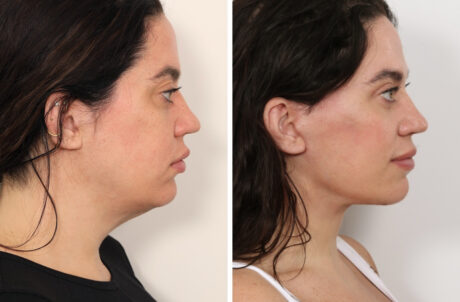 Eyelid Surgery case #3516
