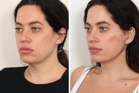 Eyelid Surgery case #3516