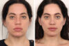 Eyelid Surgery case #3516 slider thumbnail