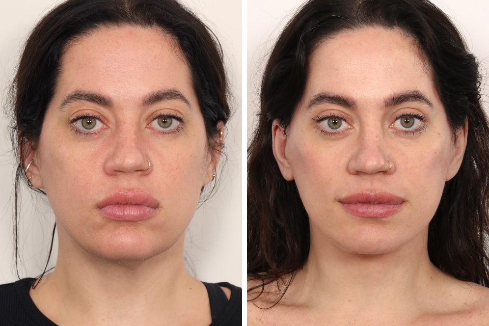 Eyelid Surgery case #3516