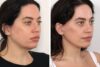 Eyelid Surgery case #3516 slider thumbnail