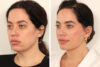 Eyelid Surgery case #3702 slider thumbnail