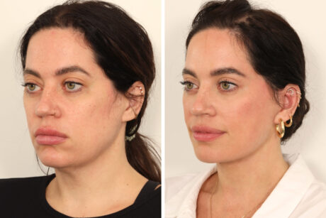 Eyelid Surgery case #3702