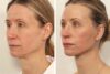 Facelift case #3517 slider thumbnail