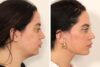 Eyelid Surgery case #3702 slider thumbnail