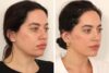 Eyelid Surgery case #3702 slider thumbnail