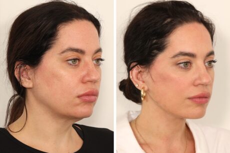 Eyelid Surgery case #3702