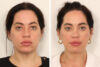 Eyelid Surgery case #3702 slider thumbnail