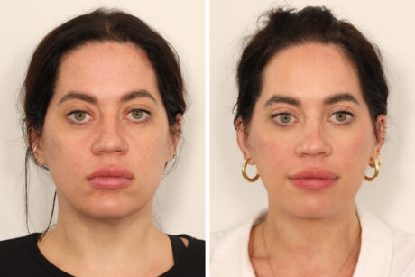 Eyelid Surgery case #3702
