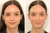 Eyelid Surgery case #3702 slider thumbnail