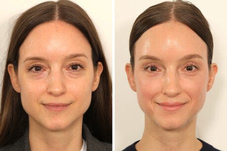 Eyelid Surgery case #3702