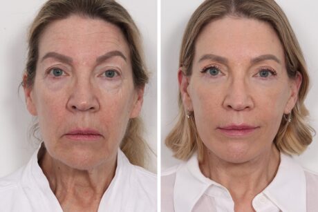 Browlift case #4319