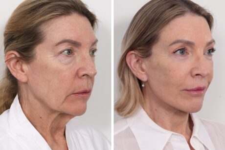 Browlift case #4319