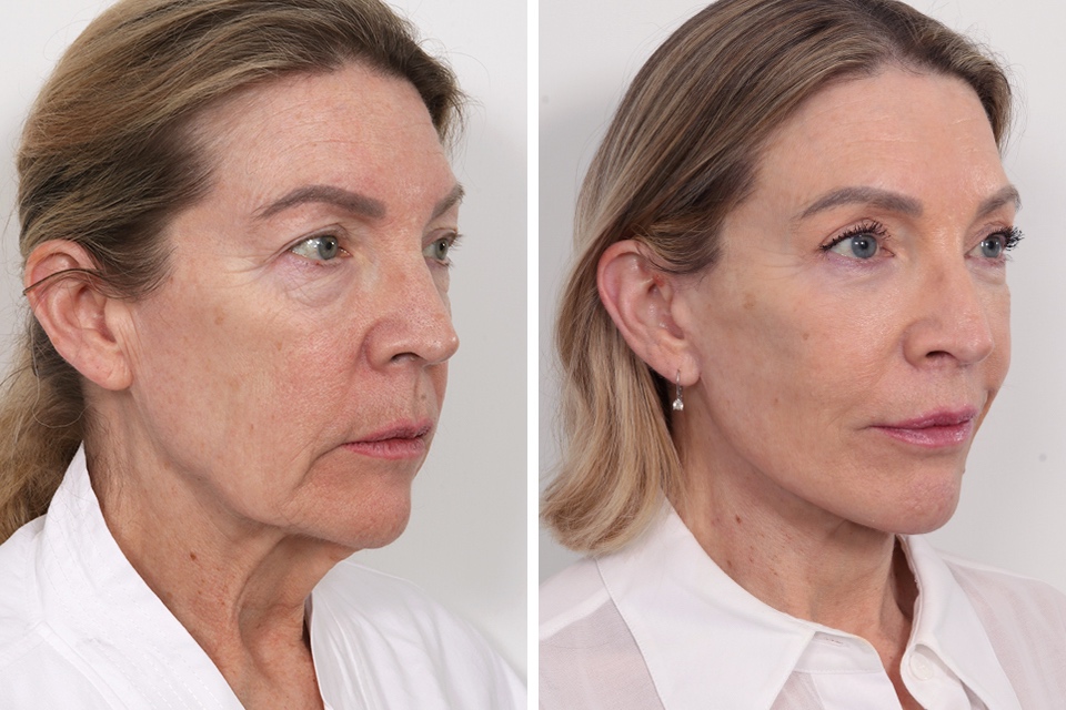 Browlift case #4319