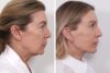Browlift case #4319 slider thumbnail