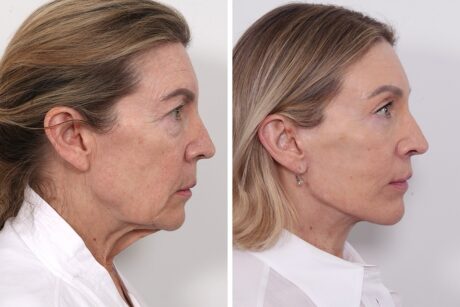 Browlift case #4319